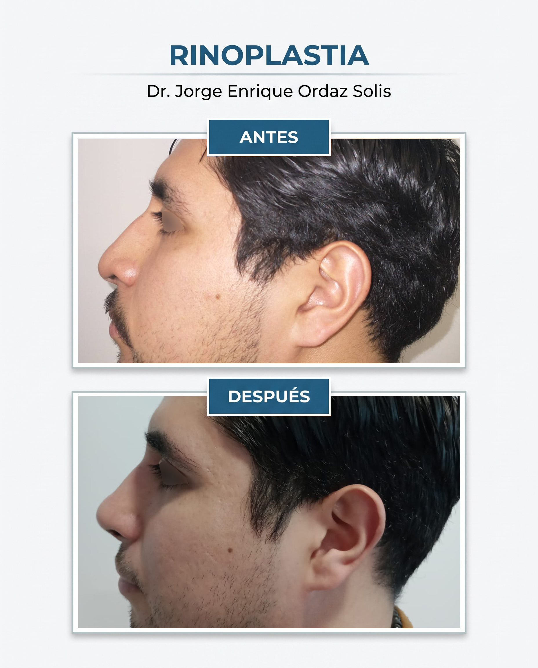 Resultado de rinoplastía, Caso 8